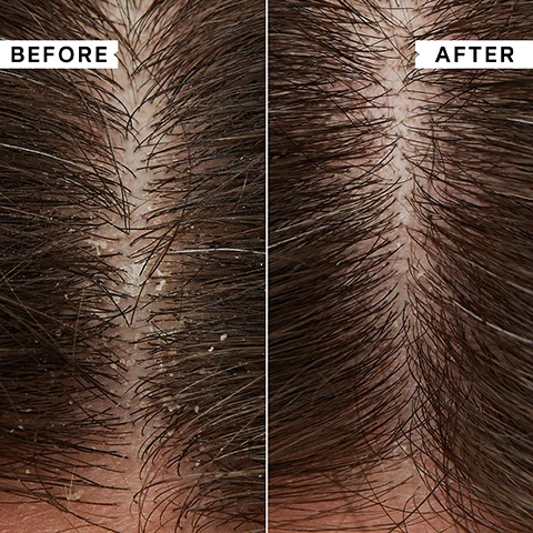 Image 1 - A close-up split image shows a scalp with visible dandruff flakes and irritation on the left, and a clean scalp with no flakes on the right, with the text BEFORE on the left and AFTER on the right. Image 2 - A white tube of Philip Kingsley Flaky / Itchy Scalp Anti-Dandruff Scalp Mask with a swirl of product beside it, next to the text Key Benefits: Calms and relieves flaky, itchy scalps, Tackles root cause of dandruff, Suitable for all hair types. Image 3 - A white tube labeled Philip Kingsley Flaky/Itchy Scalp Anti-Dandruff Scalp Mask is shown next to a dollop of white cream, with a list of Key Ingredients: PIROCTONE OLAMINE Antimicrobial to relieve flaking and itching, SALICYLIC ACID Exfoliates, GREEN TEA EXTRACT Rich in antioxidants to calm whilst tackling the root cause of flaking. Image 4 - A hand holds a white tube of Philip Kingsley Flaky/Itchy Scalp Anti-Dandruff Scalp Mask alongside a customer review that reads: This has honestly improved and cleaned my scalp so THOROUGHLY. Ive had bad dandruff build up for the better part of a decade... but this has been the best its been in years. CUSTOMER REVIEW. Image 5 - The image displays a four-step Philip Kingsley Flaky/Itchy Scalp hair care routine featuring five white products: a mask for Step 1, two cleanse options for Step 2 (one for fine/medium hair, one for curls), a conditioner for Step 3, and a toner for Step 4, with visible text stating Flaky/Itchy Scalp: To soothe and clear flakes & build-up, Step 1 Mask, Step 2 Cleanse (for fine/medium hair), Step 2 Cleanse (for curls), Step 3 Condition, and Step 4 Toner.