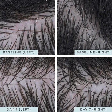 Image 1 and 2, Before and After 7 days comparison on Left and Right Baseline hair. Image 3, Women and home Hair Awards Winner 2022 Badge