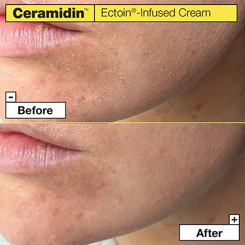 Ceramidin EctoinR-Infused Cream Before After