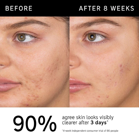 Image 1 - Image shows a side-by-side comparison of a womans face before and after eight weeks of treatment, highlighting improvement in skin clarity; visible text includes “BEFORE” above the left image, “AFTER 8 WEEKS” above the right image, and “90% agree skin looks visibly clearer after 3 days* *4-week independent consumer trial of 66 people” at the bottom.
Image 2 - A bottle of Salicylic Acid Cleanser from The Inkey List is shown with bubbles around it, accompanied by text stating it is clinically proven to visibly reduce acne blemishes and blackheads, helps minimize excess oil, and is non-drying, non-stripping, and non-irritating.
Image 3 - Close-up of a smiling person with dark skin and braided hair on one side, with text stating that 90% agree skin looks visibly clearer after 3 days, 93% agree skin instantly looks and feels less oily, and 92% agree skin did not feel tight or stripped, along with a note about the consumer trial.
Image 4 - Image shows a clear liquid with bubbles and text listing ingredients: 2% salicylic acid - works deep within pores to help unclog and gently exfoliate, 0.5% allantoin - helps soothe and comfort skin, zinc compound - helps reduce excess oil.
Image 5 - A close-up image of a persons face with cleanser applied, and text that reads: FAQ, CAN I USE THIS DAILY? Yes, for best results use AM and PM daily. For sensitive, blemish-prone, or dehydrated skin, use 2 - 3 times per week. CAN I USE ON MY BODY? Yes, you can use Salicylic Acid Cleanser on other blemish-prone areas, including the back and chest.
Image 6 - Image shows a glossy, clear drop of liquid against a light background with text above reading How to layer your routine and five numbered steps below: 1 Clean, 2 Hydrate, 3 Treat, 4 Moisturize, 5 SPF.
Image 7 - A hand holds a bottle of Salicylic Acid Cleanser by The INKEY List, with icons indicating when to apply: a sun for AM and a moon for PM, accompanied by the text When to apply.