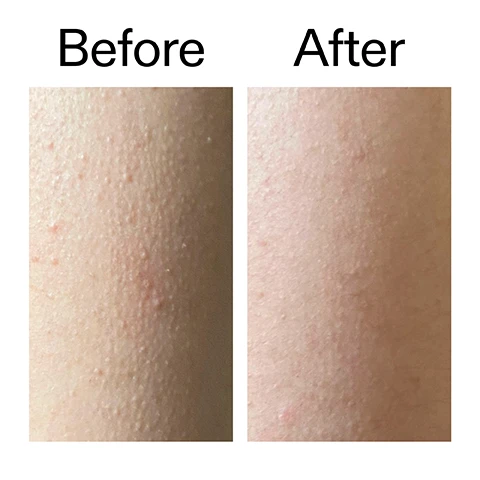 Image 1 - A before and after comparison of skin, with the left image showing bumpy, red skin and the right image showing smoother skin with fewer bumps, accompanied by the text Before and After. Image 2 - A before and after comparison of a foot heel showing dry, cracked skin on the left and smooth, moisturized skin on the right, with the text Before After. Image 3 - A woman holds a white and black body stick labelled GLYCOLIC ACID EXFOLIATING BODY STICK by THE INKEY LIST, with accompanying text on the right stating Visibly improves, dry, rough and flakey skin after first use*, Visibly reduces ingrown hairs after 7 days*, Visibly improves dry, hard, cracked heels in 3 days*, and a disclaimer *4 week consumer study of 100 people. Image 4 - A person holds a white and black product stick labeled GLYCOLIC ACID EXFOLIATING BODY STICK by THE INKEY LIST to their shoulder, with additional text reading Why we love it, Smooths and softens skin, Rinse-free and mess-free, Non-sticky, non-oily texture. Image 5 - A white cream is swiped across a white background next to text that reads Why it works 7% Glycolic Acid SMOOTHS AND SOFTENS ROUGH, BUMPY SKIN. 0.5% Salicylic Acid UNCLOGS OILY PORES AND REDUCES BLEMISHES. 10% Shea Butter INSTANTLY NOURISHES AND HYDRATES. Image 6 - A hand holds a white and black Glycolic Acid Exfoliating Body Stick, positioned below usage instructions that read How to use USE AM + PM. GLIDE ON CLEAN, DRY SKIN. START 2-3 TIMES A WEEK, BUILD UP TO DAILY USE IF NECESSARY. FOLLOW WITH BODY MOISTURISER, IF DESIRED. The product label also shows THE INKEY LIST Net Wt. 1.5 Oz. / 45g e GLYCOLIC ACID EXFOLIATING BODY STICK Specialist exfoliating treatment for multiple concerns.