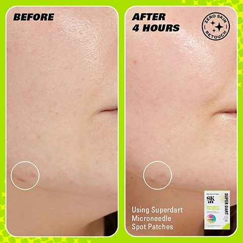 Image 1 - Side-by-side comparison of facial skin showing a blemish marked in a circle on the left labeled Before and the same area on the right labeled After 4 Hours with visible improvement, with text at the bottom stating Using Superdart Microneedle Spot Patches.
Image 2 - Image shows a side-by-side comparison of two product packages for microneedle spot patches labeled Previous and New Packaging, with the previous package white and green, and the new one colorful with a modern design, featuring product information and the text WEVE HAD A GLOW UP! at the top and NEW LOOK. SAME INCREDIBLE FORMULA. at the bottom.