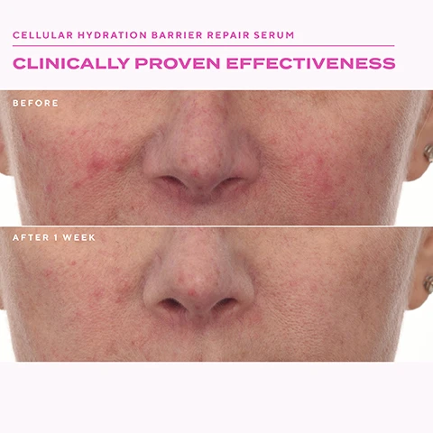 Image 1 - A before and after comparison of skin showing reduced redness and smoother appearance after 1 week, with the text CELLULAR HYDRATION BARRIER REPAIR SERUM CLINICALLY PROVEN EFFECTIVENESS BEFORE AFTER 1 WEEK. Image 2 - Before and after comparison image of a forehead showing wrinkles reduced after 2 weeks, with the text Retinol Youth Renewal Serum Clinically Proven Effectiveness Before After 2 Weeks. Image 3 - A split image shows a persons skin near the nose before and after treatment, with the top image showing more visible dark spots and uneven texture than the bottom image, alongside the text RAPID DARK SPOT CORRECTING SERUM CLINICALLY PROVEN EFFECTIVENESS BEFORE AFTER 2 WEEKS. Image 4 - A woman smiling shows her skin next to a bottle of Murad Retinol Youth Renewal Serum with text that reads CLINICALLY PROVEN EFFECTIVENESS Murad Retinol Youth Renewal Serum Sérum rajeunissant au rétinol RETINOL YOUTH RENEWAL SERUM SMOOTHS WRINKLES & BOOSTS RADIANCE IN 2 WEEKS *Proven results reported by trial participants in on 8-week clinical study. Image 5 - A woman smiles next to a bottle of Murad Cellular Hydration Repair Serum, with text reading CLINICALLY PROVEN EFFECTIVENESS, CELLULAR HYDRATION REPAIR SERUM, HYDRATES & REPAIRS SKIN BARRIER IN 30 MINUTES, Based on a 4-week clinical study with 47 participants, ranging in Fitzpatrick Types 1-6. Image 6 - A woman with serum on her cheek is shown next to a bottle of Murad Rapid Dark Spot Correcting Serum with the text CLINICALLY PROVEN EFFECTIVENESS RAPID DARK SPOT CORRECTING SERUM REDUCES THE LOOK OF DARK SPOTS IN 2 WEEKS *Clinically proven results via instrumental measurement of areas with dark spots. Murad Rapid Dark Spot Correcting Serum Sérum correcteur anti-taches pigmentaires à action rapide. Image 7 - A graphic explains how to use best selling serums with steps 1 Cleanse showing a tube icon, 2 Treat showing a bottle icon with text Apply serums evenly over face and neck, 3 Moisturise showing a jar icon, and a Tip section titled SKIN CYCLING with text Use Rapid Dark Spot Correcting Serum in the morning and Retinol Youth Renewal Serum at night On alternate days use Cellular Hydration Repair Serum both morning and night.